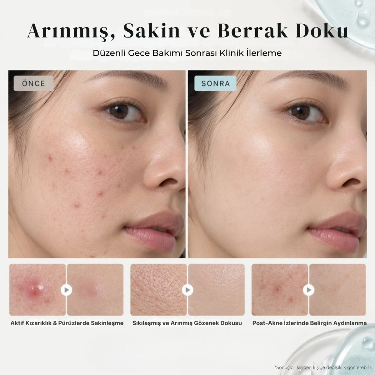 Needle Serum AZ ile düzenli gece bakımı öncesi ve sonrası cilt görünümü